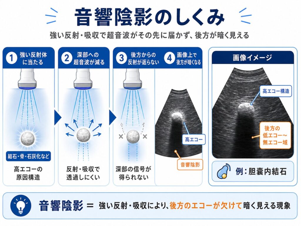 強い反射・吸収を起こす結石や石灰化の後方で超音波が届かず、画像上で暗く表示される音響陰影のしくみを示した図